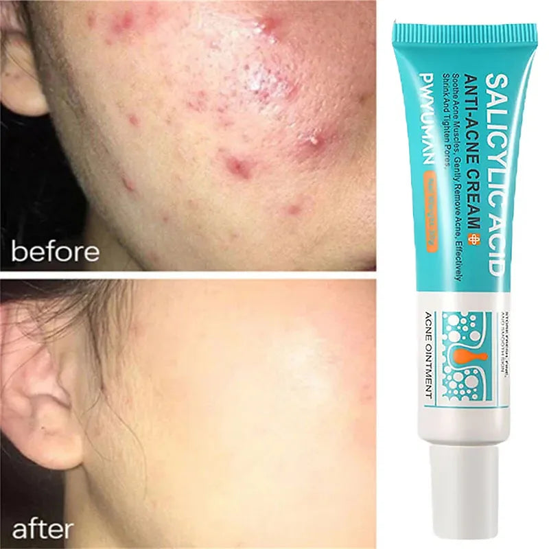 Salicylic Acid Anti-Acne Cream