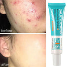 Salicylic Acid Anti-Acne Cream