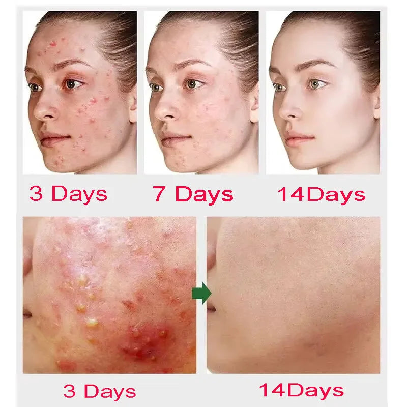 Salicylic Acid Anti-Acne Cream