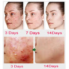 Salicylic Acid Anti-Acne Cream